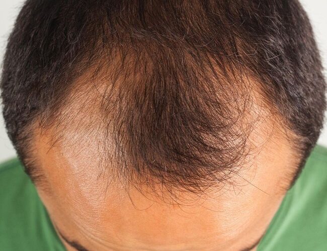 Alopecia Androgenetica